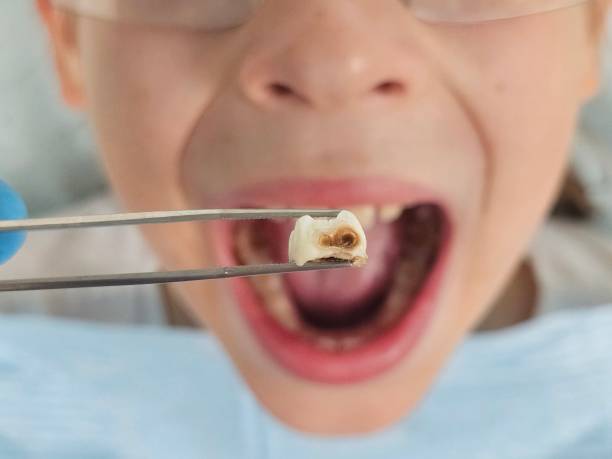 Best Emergency Dental Care for Broken or Chipped Teeth in Summersville, WV